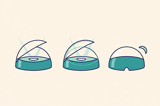 LASIK vs Femto-LASIK vs SMILE Pro : quelle est la différence ?