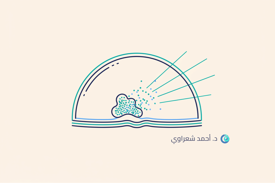 ندب القرنية: الأسباب والعلاج وإمكانية استعادة الرؤية ندب القرنية: الأسباب والعلاج وإمكانية استعادة الرؤية