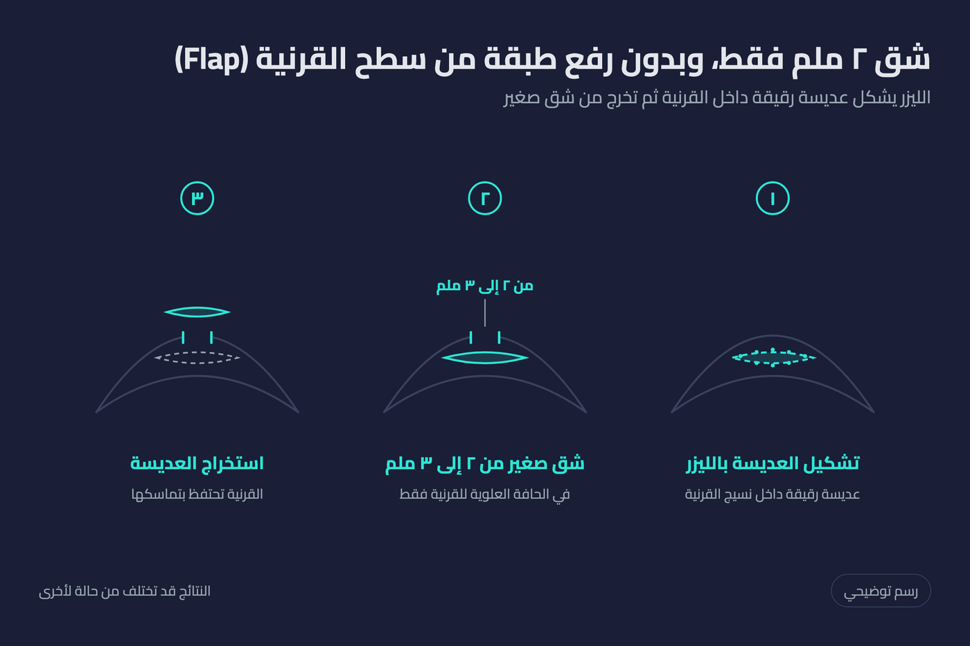 رسم توضيحي لخطوات عملية سمايل برو: تشكيل العديسة داخل القرنية واستخراجها من شق صغير بدون رفع طبقة من سطح القرنية (Flap)