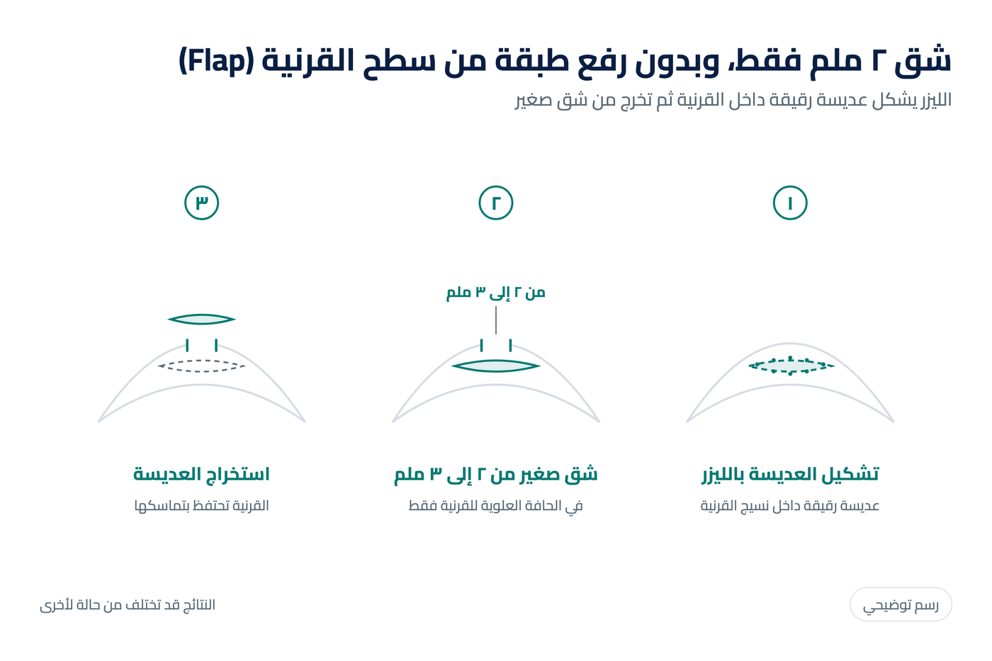 رسم توضيحي لخطوات عملية سمايل برو: تشكيل العديسة داخل القرنية واستخراجها من شق صغير بدون رفع طبقة من سطح القرنية (Flap)