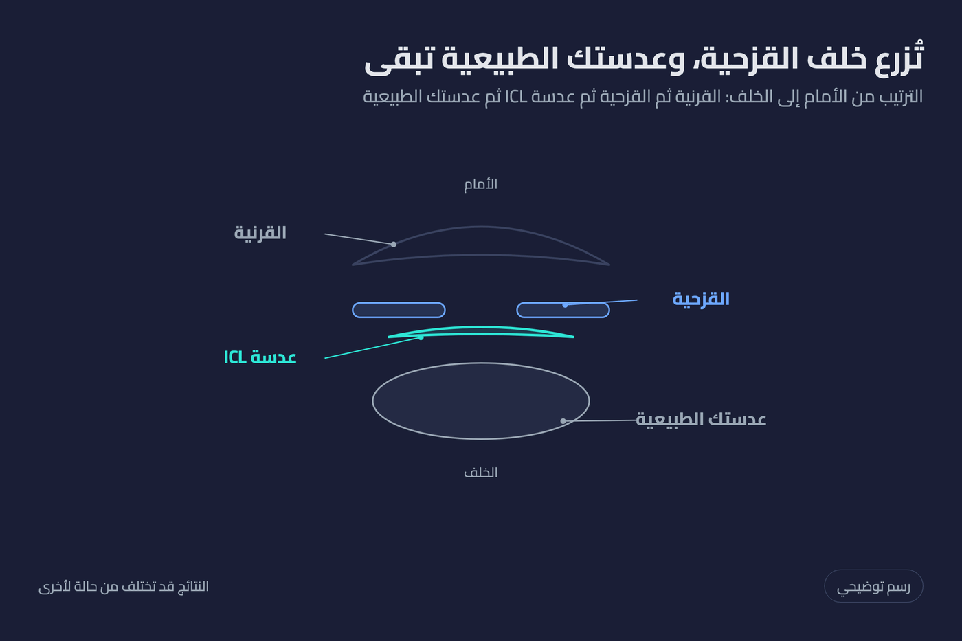 رسم توضيحي لمكان زراعة عدسة ICL خلف القزحية وأمام العدسة الطبيعية للعين
