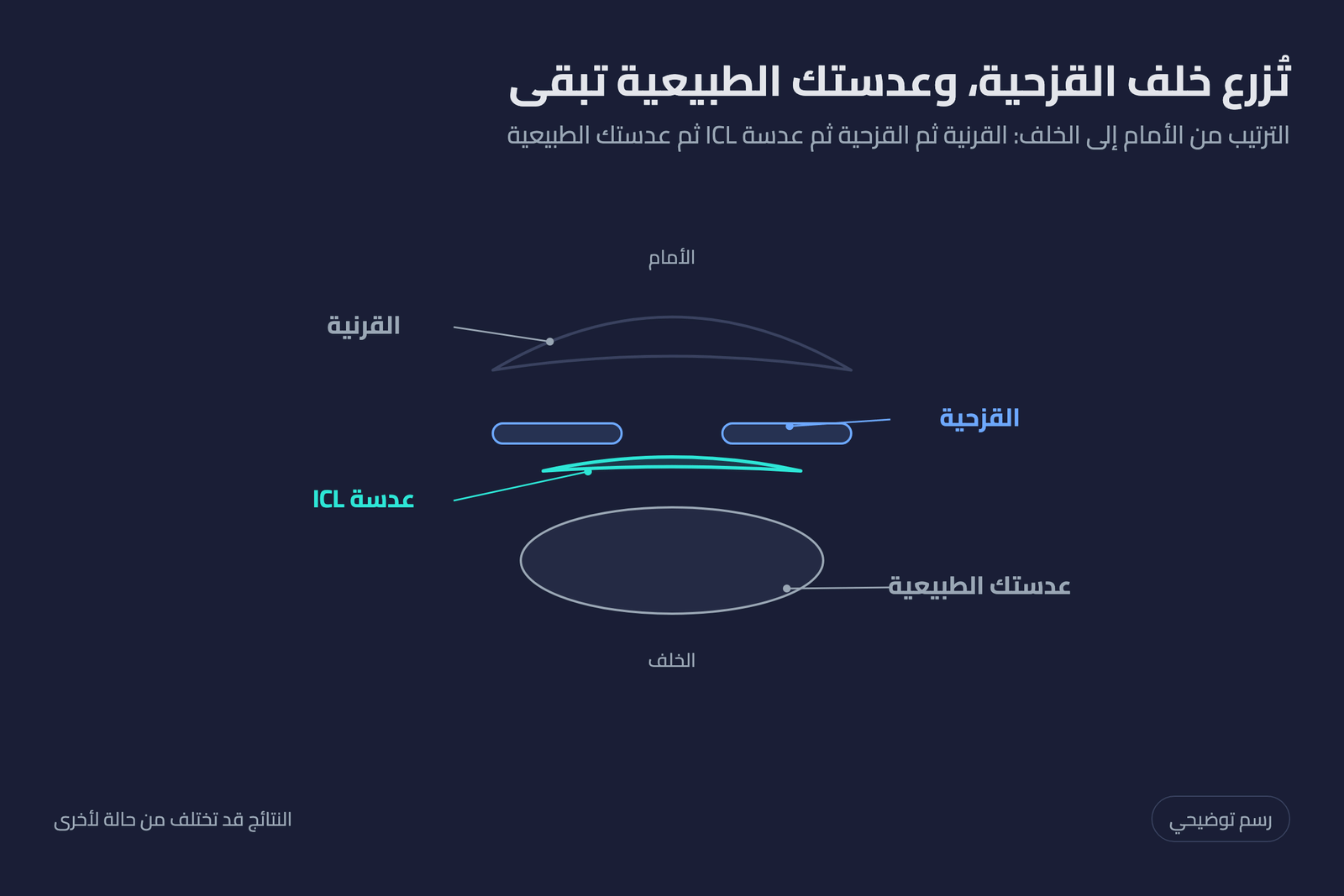 رسم توضيحي لمكان زراعة عدسة ICL خلف القزحية وأمام العدسة الطبيعية للعين