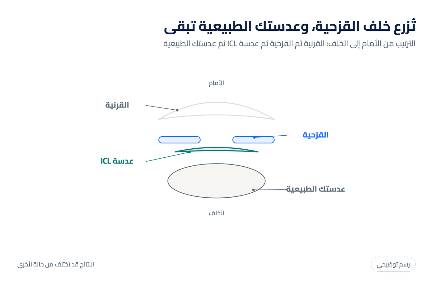 رسم توضيحي لمكان زراعة عدسة ICL خلف القزحية وأمام العدسة الطبيعية للعين