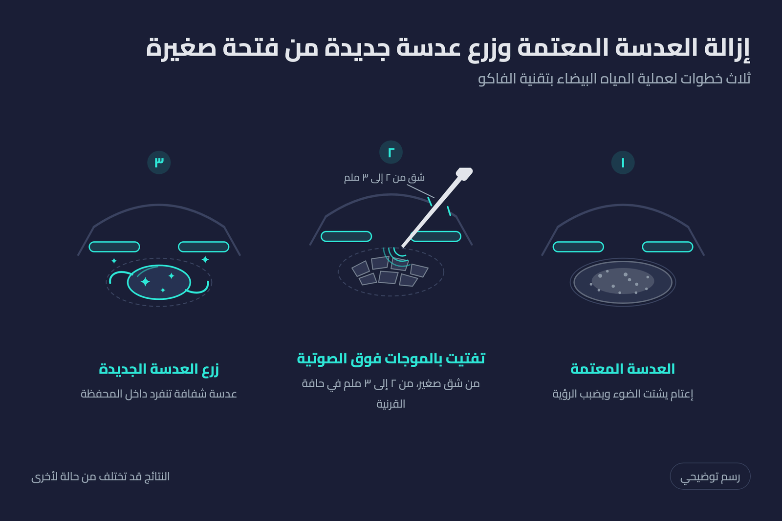 رسم توضيحي لخطوات عملية المياه البيضاء بتقنية الفاكو: تفتيت العدسة المعتمة بالموجات فوق الصوتية وزرع عدسة جديدة من فتحة صغيرة