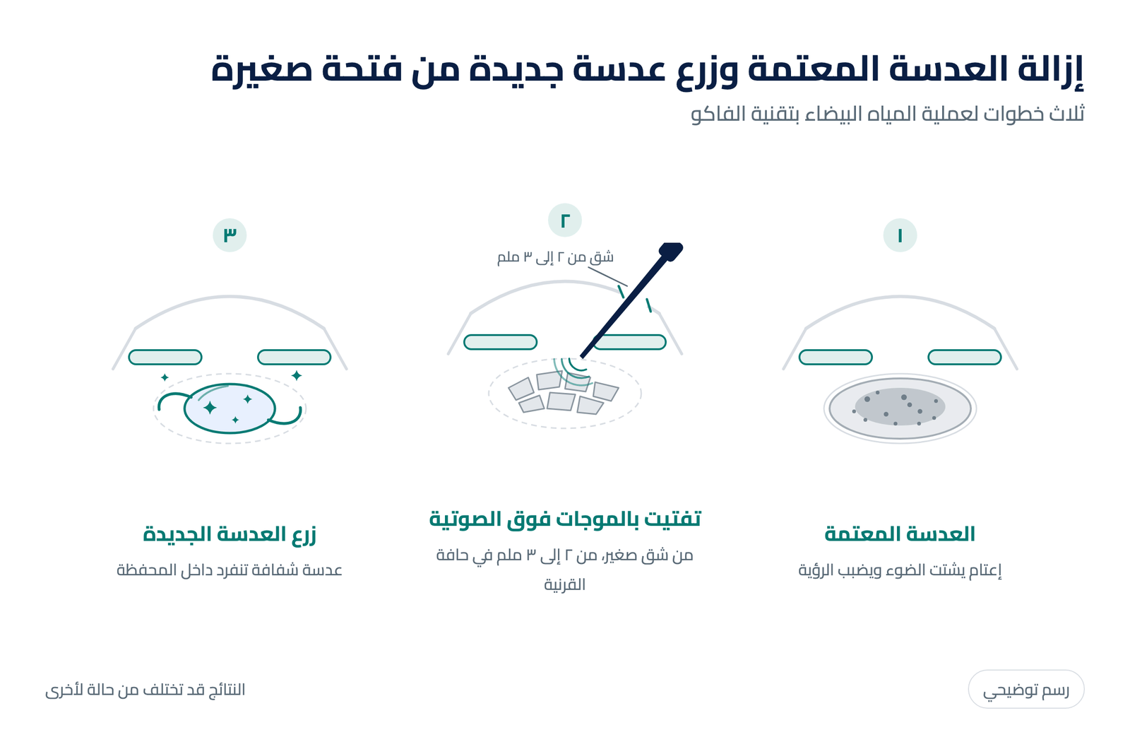 رسم توضيحي لخطوات عملية المياه البيضاء بتقنية الفاكو: تفتيت العدسة المعتمة بالموجات فوق الصوتية وزرع عدسة جديدة من فتحة صغيرة