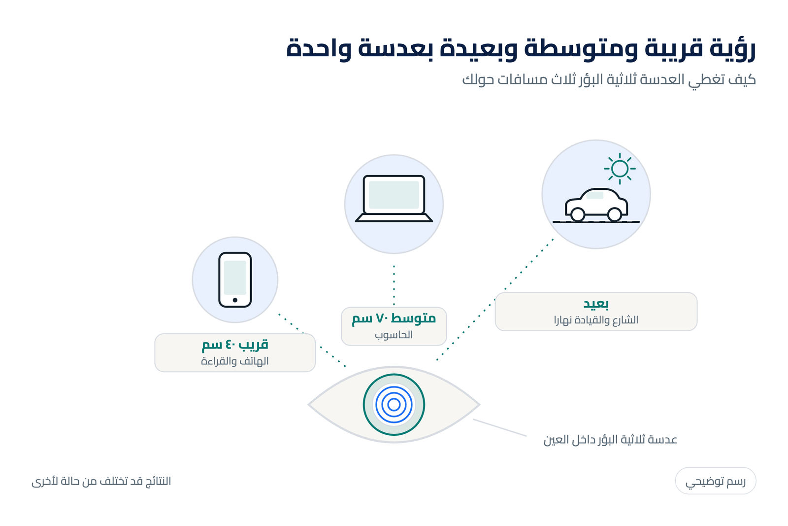 رسم توضيحي لمسافات الرؤية الثلاث مع العدسة ثلاثية البؤر: قريب ٤٠ سم ومتوسط ٧٠ سم وبعيد