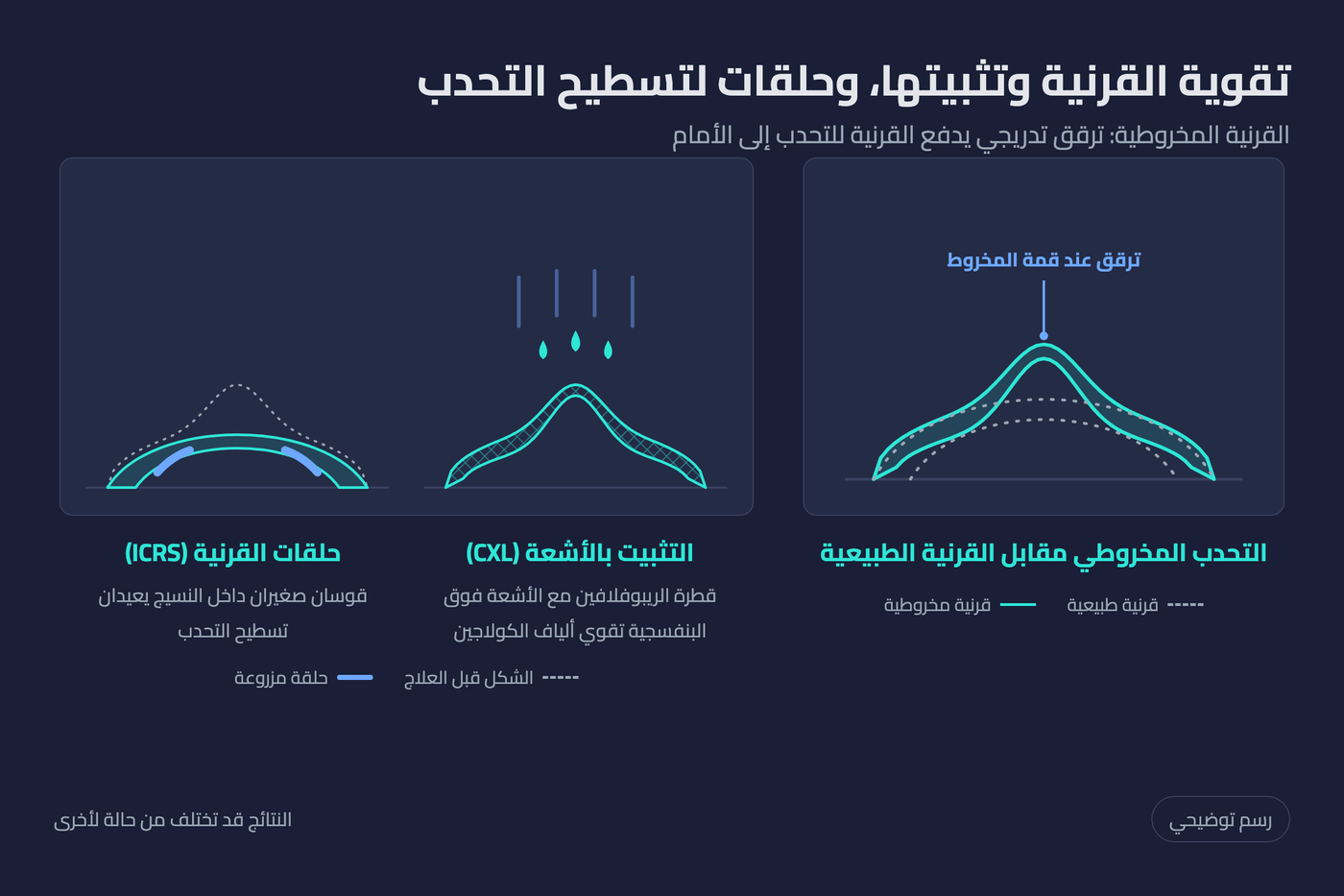 رسم توضيحي للقرنية المخروطية مقارنة بالطبيعية وعلاجها بتثبيت القرنية بالأشعة وحلقات القرنية