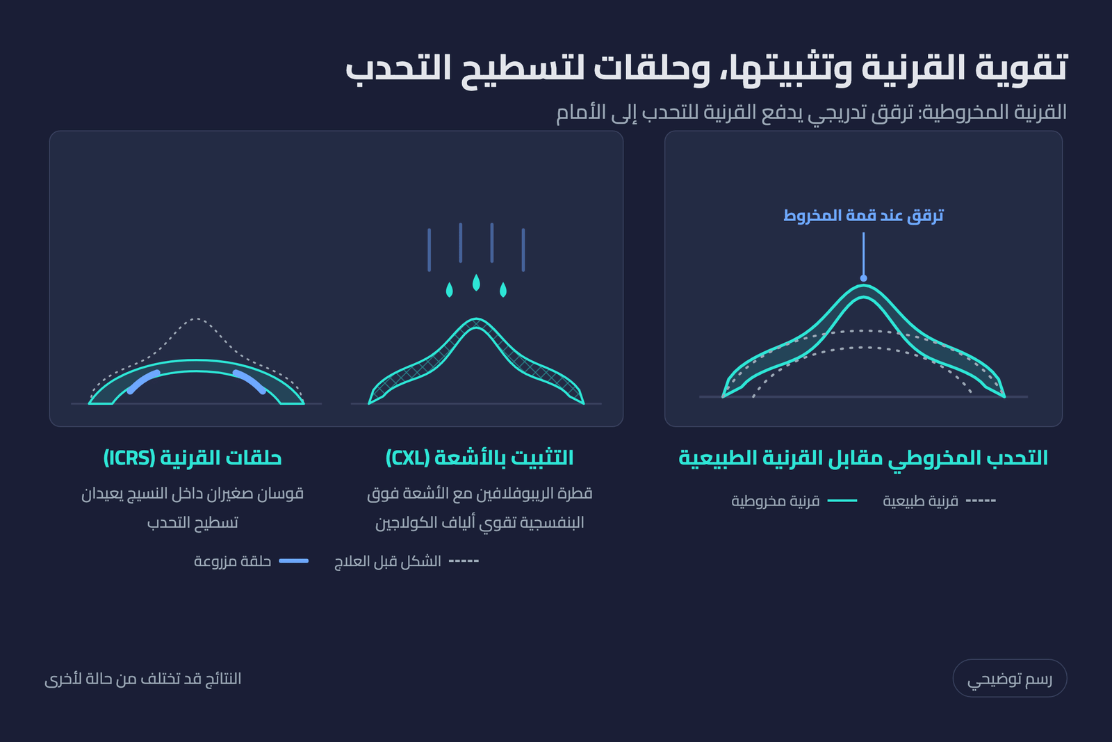 رسم توضيحي للقرنية المخروطية مقارنة بالطبيعية وعلاجها بتثبيت القرنية بالأشعة وحلقات القرنية