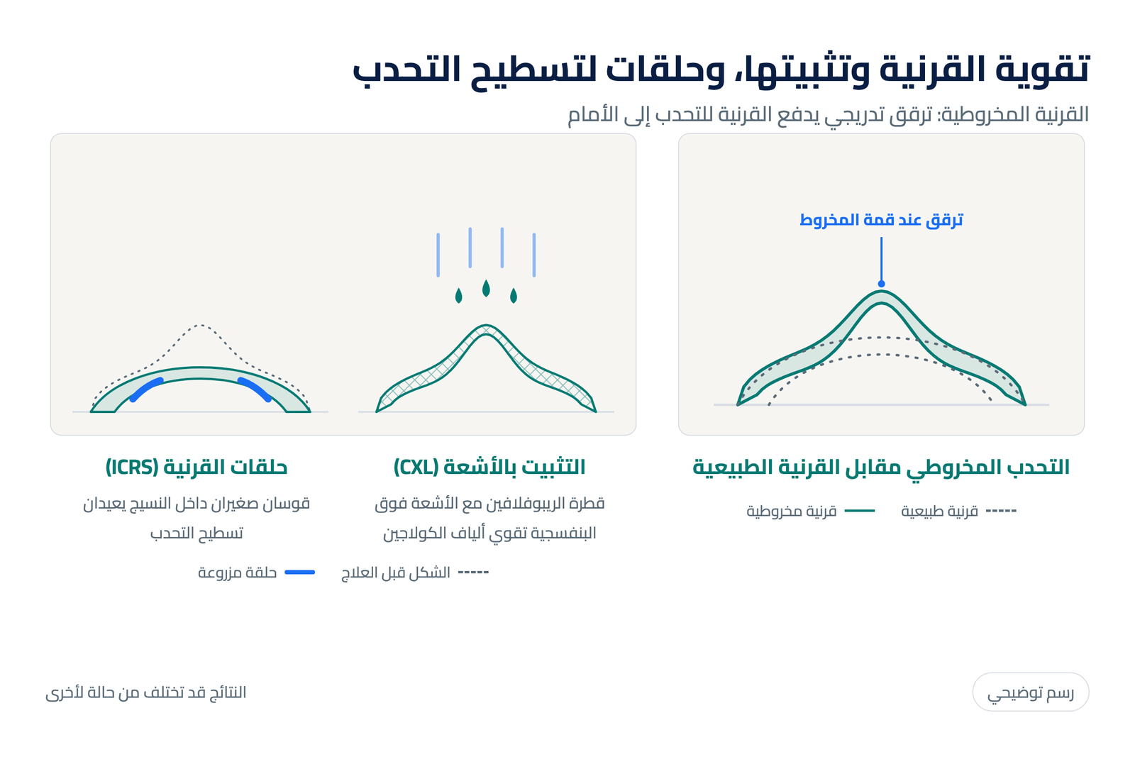 رسم توضيحي للقرنية المخروطية مقارنة بالطبيعية وعلاجها بتثبيت القرنية بالأشعة وحلقات القرنية