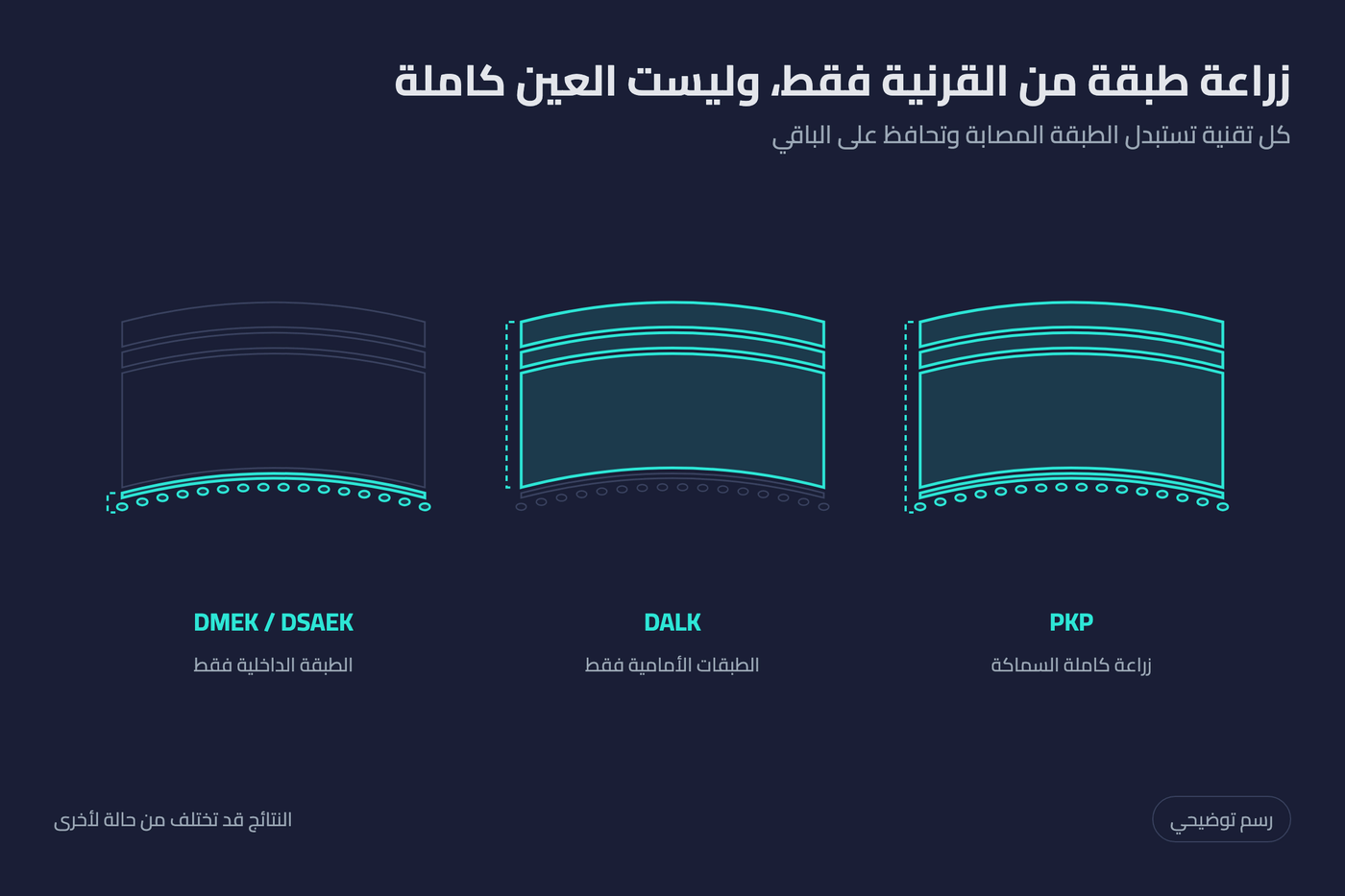 رسم توضيحي لطبقات القرنية وما يتم استبداله في كل تقنية زراعة: PKP كاملة السماكة وDALK الطبقات الأمامية وDMEK وDSAEK الطبقة الداخلية فقط