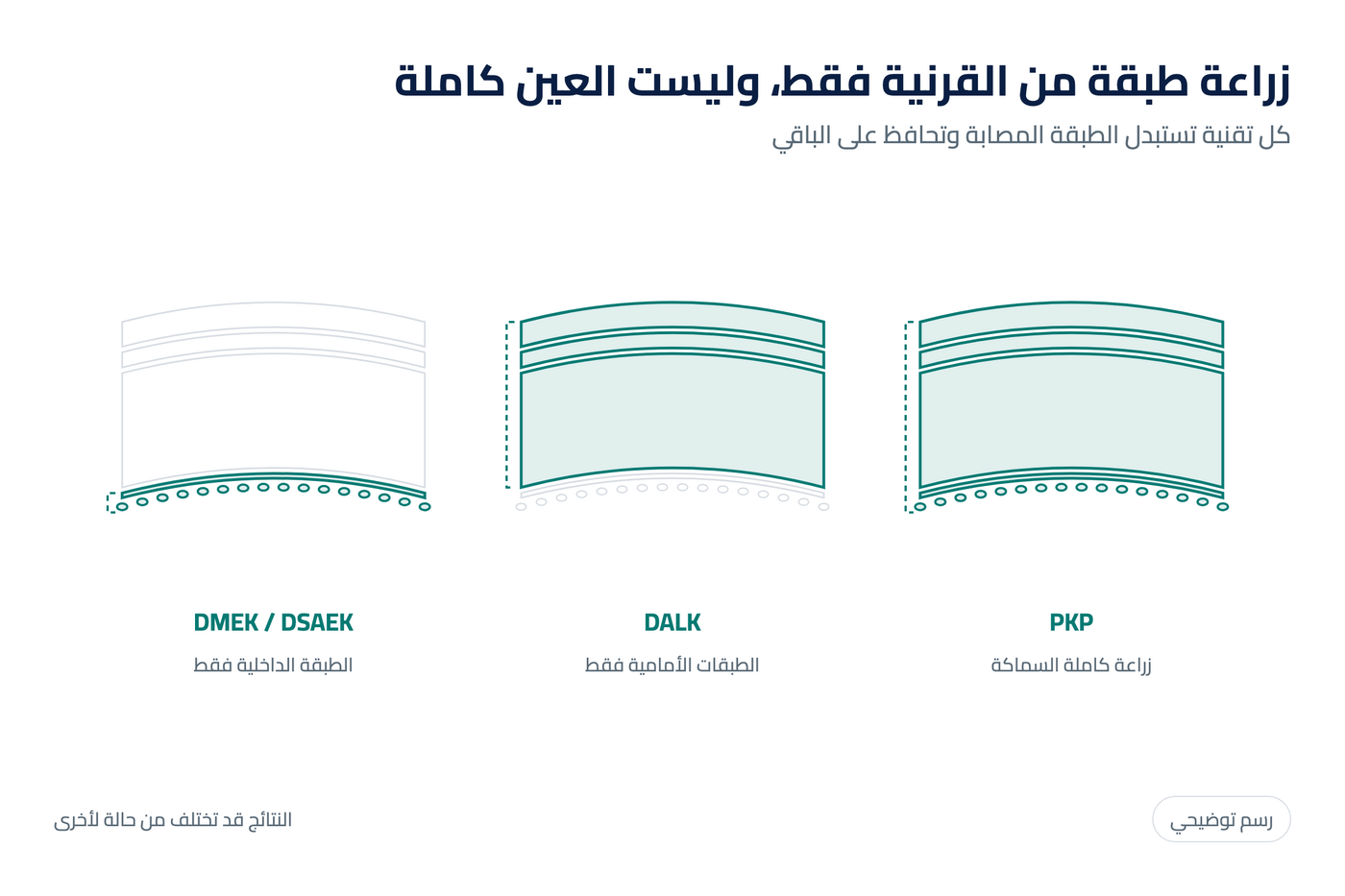رسم توضيحي لطبقات القرنية وما يتم استبداله في كل تقنية زراعة: PKP كاملة السماكة وDALK الطبقات الأمامية وDMEK وDSAEK الطبقة الداخلية فقط