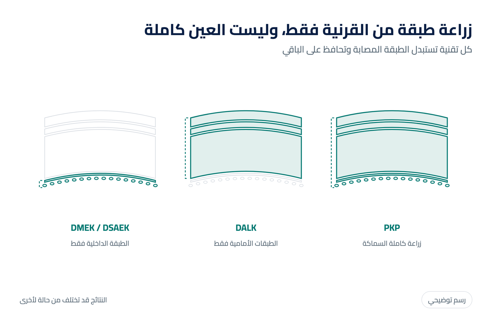 رسم توضيحي لطبقات القرنية وما يتم استبداله في كل تقنية زراعة: PKP كاملة السماكة وDALK الطبقات الأمامية وDMEK وDSAEK الطبقة الداخلية فقط